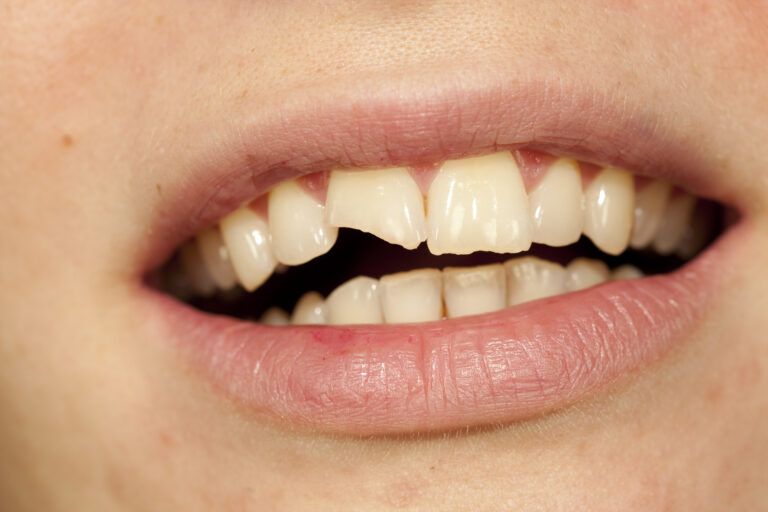 Treatment of a broken tooth