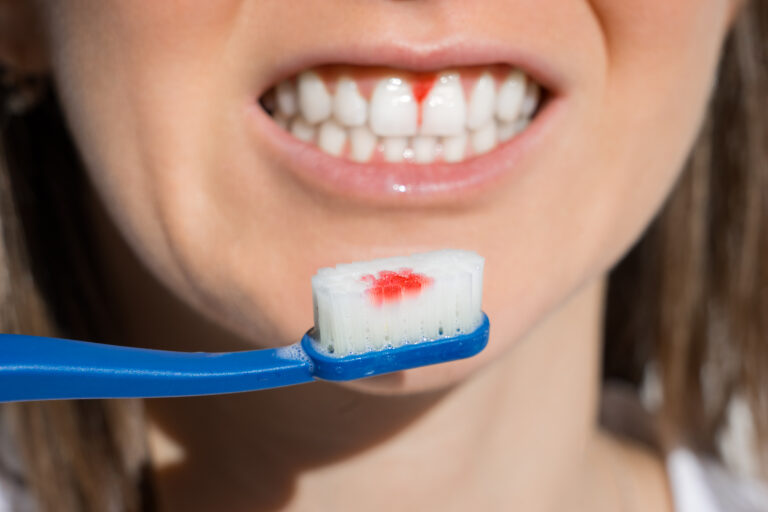 Treatment for Bleeding Gums