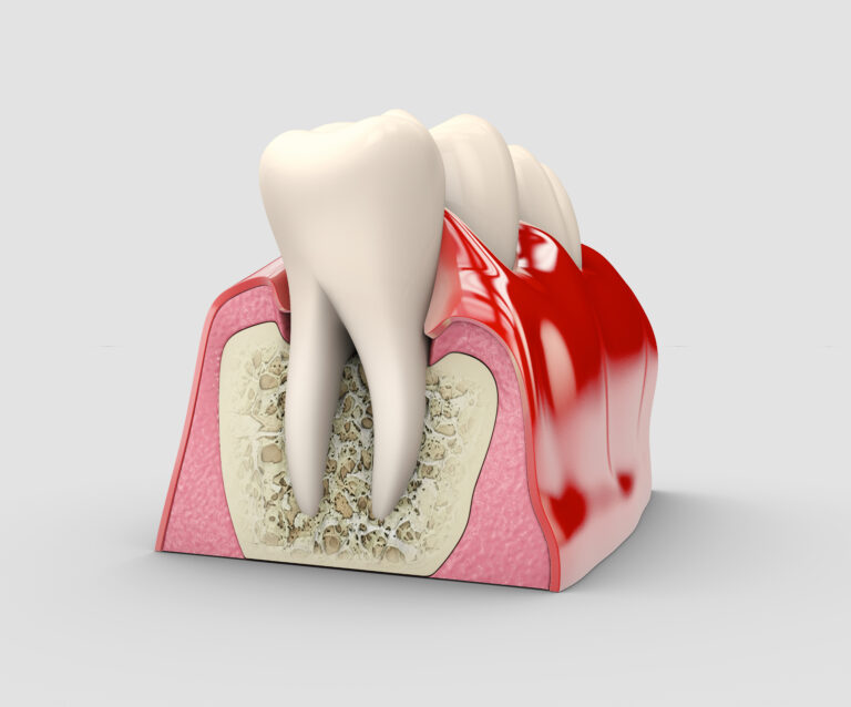 Closed curettage 
