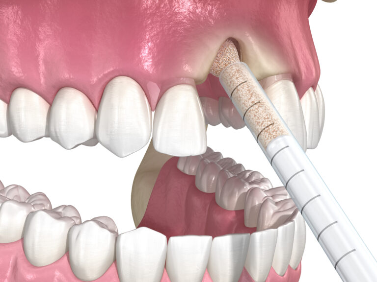 Augmentace zubní kosti (osteoplastika)