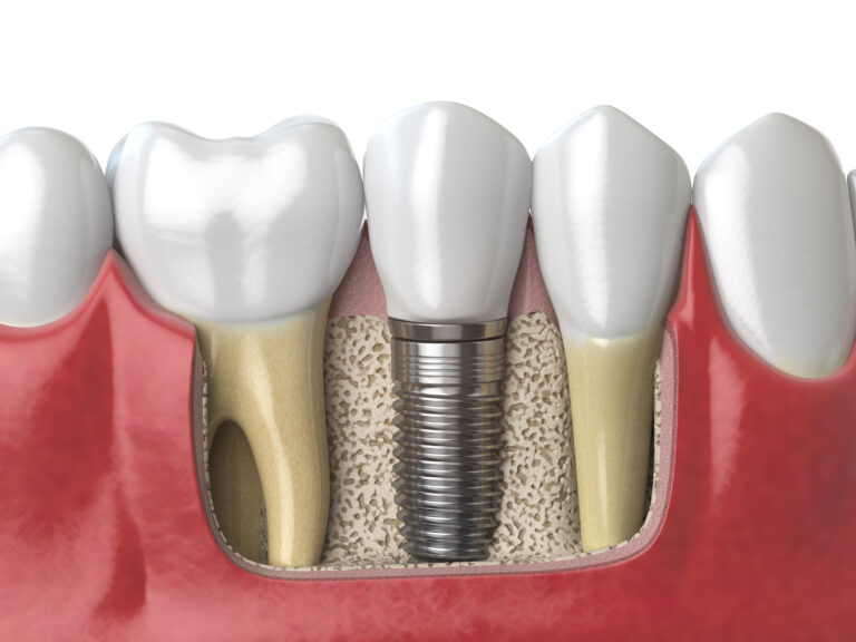 Имплантаты JD Dental