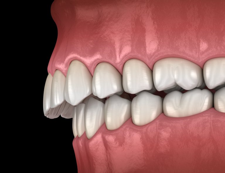 Treatment of malocclusion in children – pediatric orthodontics