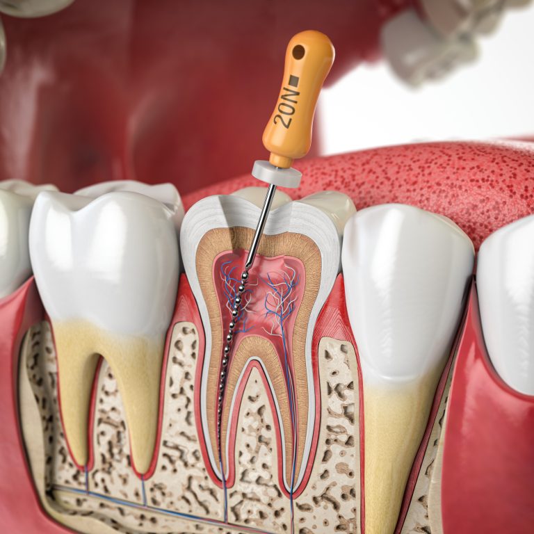 Reendodoncie kořenových kanálků