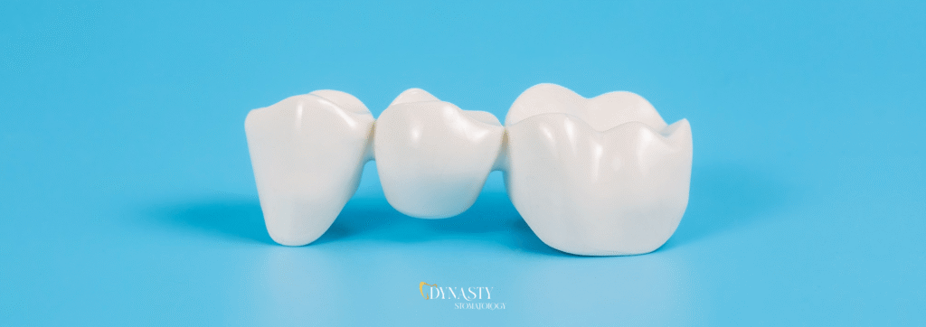 What Is a Dental Bridge – Types, Benefits