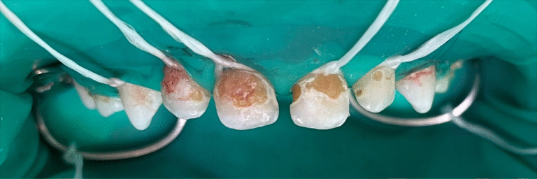 Comprehensive treatment of primary teeth under general anesthesia