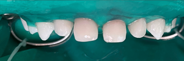 Comprehensive treatment of primary teeth under general anesthesia