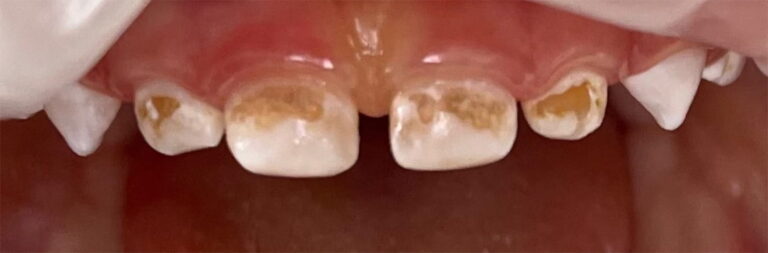 Comprehensive treatment of primary teeth under general anesthesia