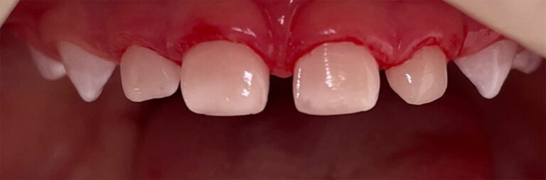 Comprehensive treatment of primary teeth under general anesthesia