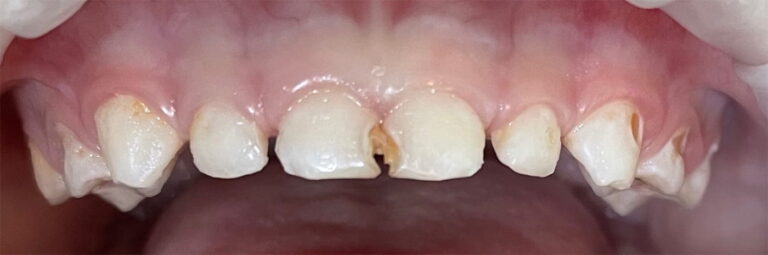 Comprehensive treatment of primary teeth under general anesthesia