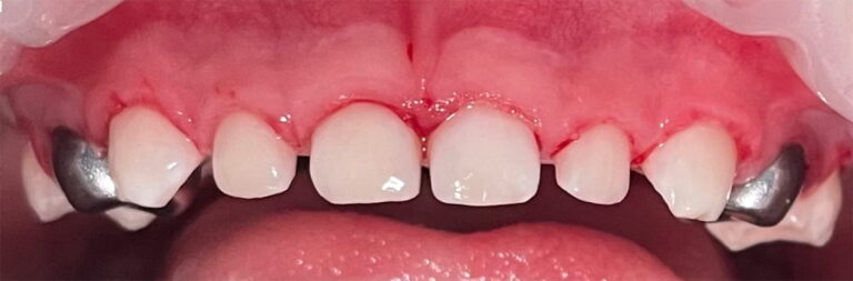 Comprehensive treatment of primary teeth under general anesthesia