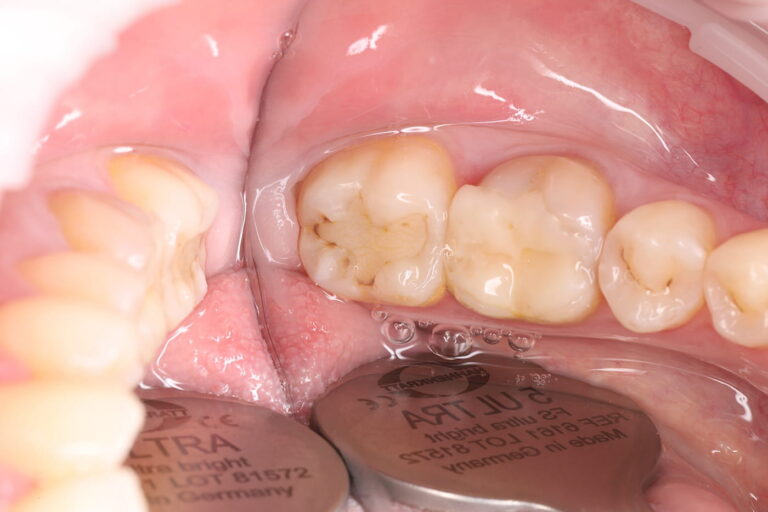Treatment of a secondary carious lesion