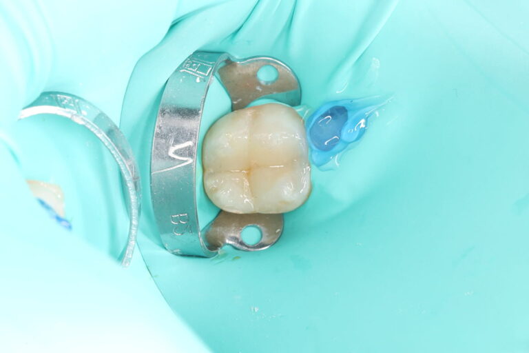 Treatment of a secondary carious lesion