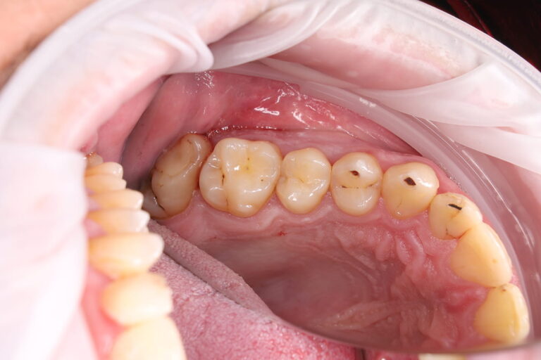 Caries treatment and aesthetic restoration with composite material.
