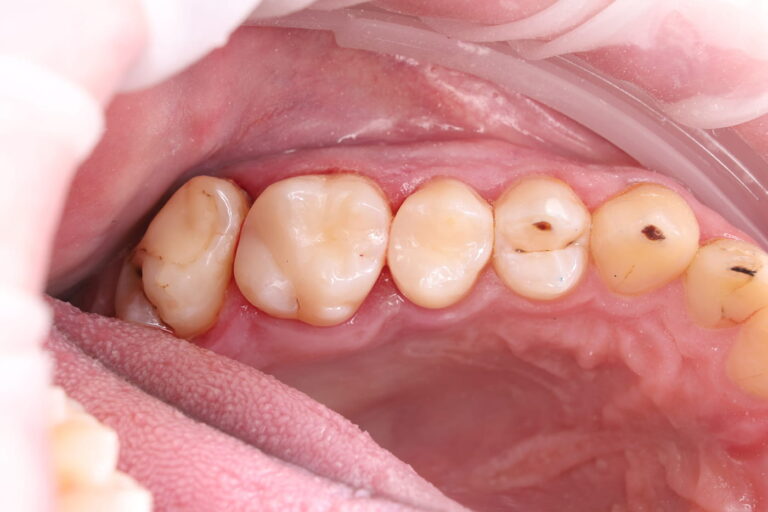 Caries treatment and aesthetic restoration with composite material.