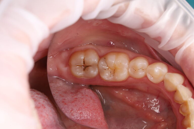 Removal of carious tissues and restoration of the contact surface between teeth 46 and 47, as well as composite restoration of the cervical area of tooth 47.