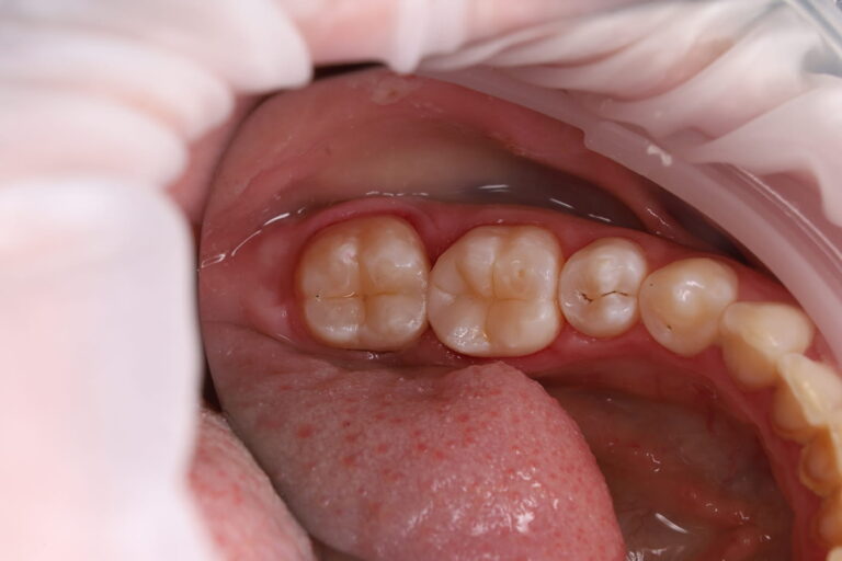 Removal of carious tissues and restoration of the contact surface between teeth 46 and 47, as well as composite restoration of the cervical area of tooth 47.