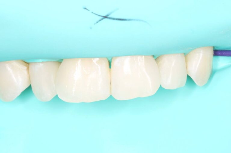Removal of carious tissues and aesthetic composite restoration of the teeth with anatomical reconstruction.