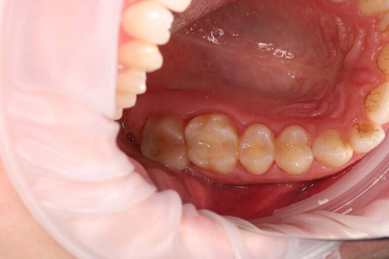 Treatment of secondary caries and aesthetic restoration with composite material.