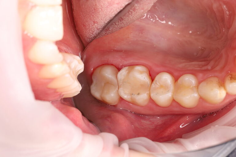 Treatment of secondary caries and aesthetic restoration with composite material.