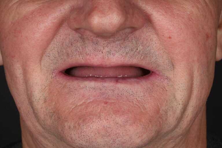 Full-Arch Rehabilitation of the Upper jaw Using the All-on-4 Concept