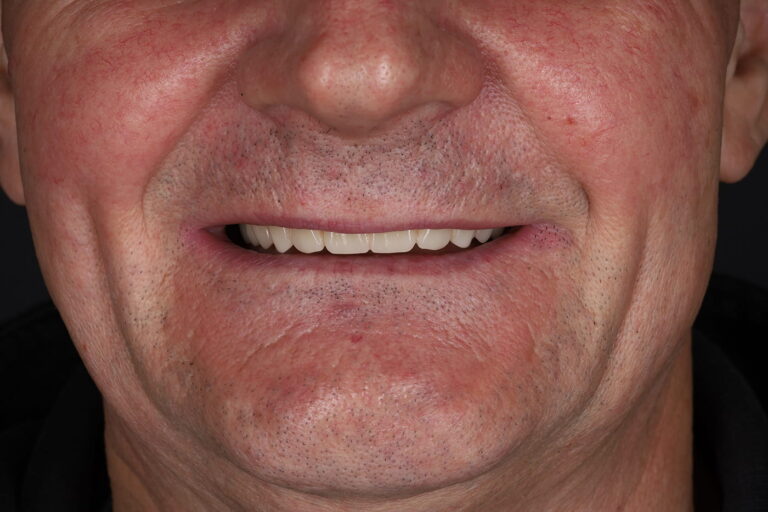 Full-Arch Rehabilitation of the Upper jaw Using the All-on-4 Concept