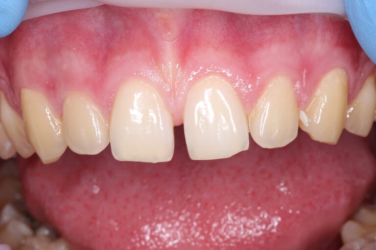 Aesthetic Closure of Diastema Using Composite Restoration