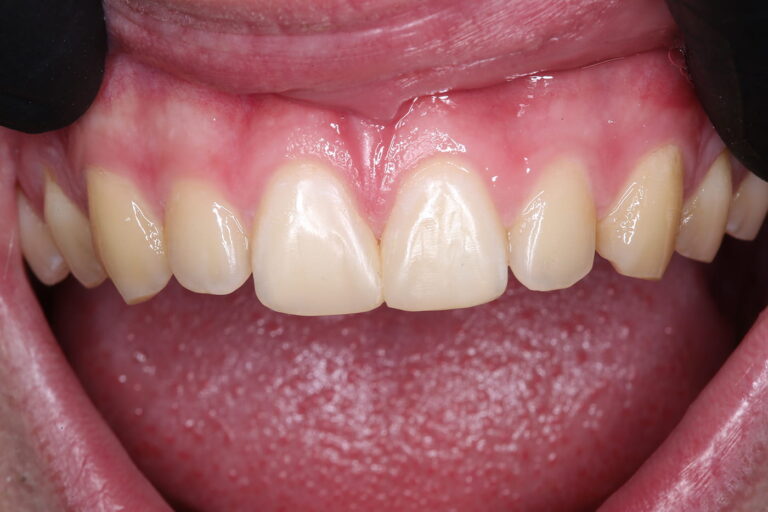 Aesthetic Closure of Diastema Using Composite Restoration