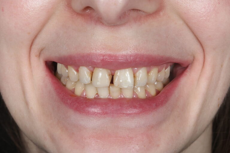 Comprehensive Smile Rehabilitation with Orthodontics, Dental Implants, and Ceramic Crowns