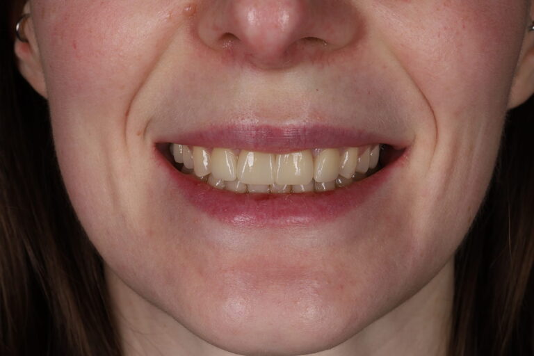 Comprehensive Smile Rehabilitation with Orthodontics, Dental Implants, and Ceramic Crowns