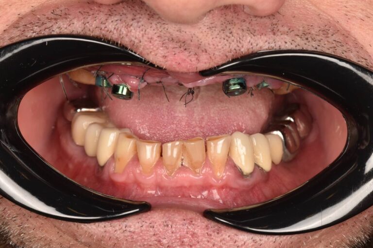 Comprehensive Smile Rehabilitation with Implant Placement and Implant-Supported Prosthetics