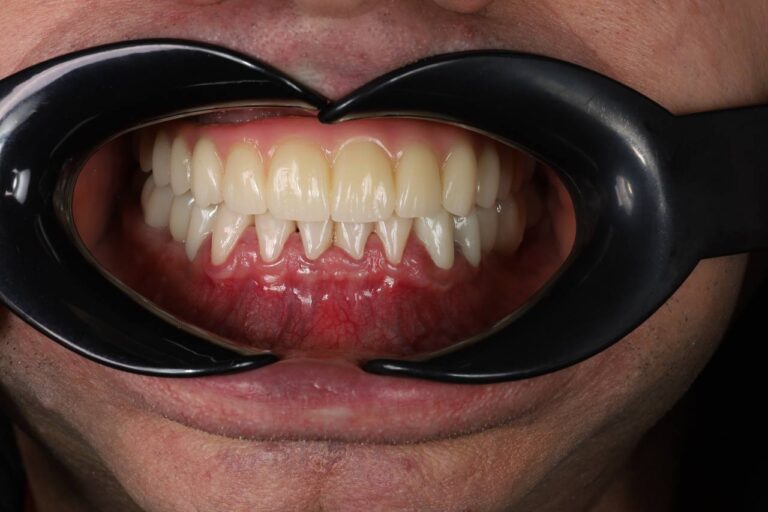 Comprehensive Smile Rehabilitation with Implant Placement and Implant-Supported Prosthetics