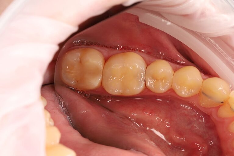 Treatment of interproximal caries after completion of orthodontic treatment.