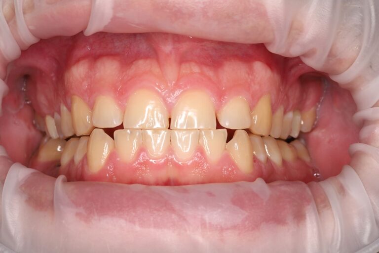 Professional tooth whitening using the Beyond system.
