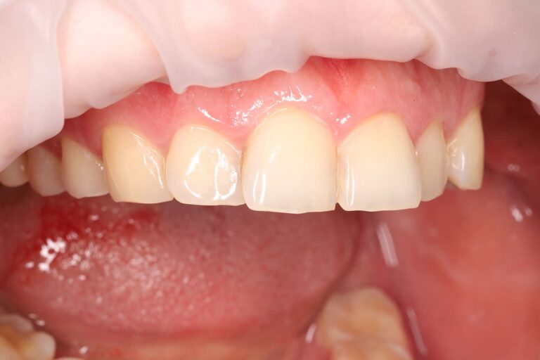 Treatment of secondary caries prior to orthodontic treatment.