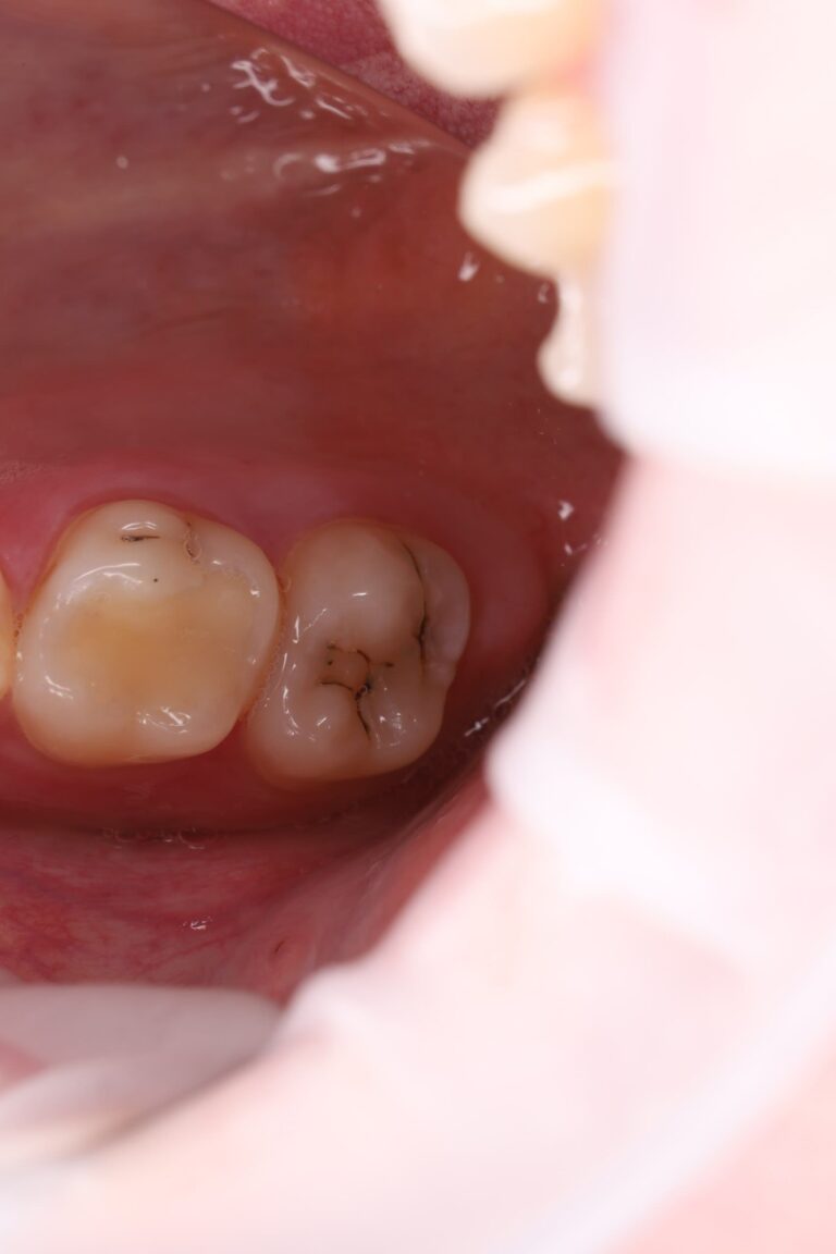 Treatment of interproximal caries and aesthetic restoration with composite material.