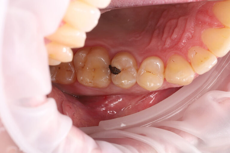 Microscope-assisted endodontic treatment and tooth restoration for subsequent prosthetic rehabilitation.