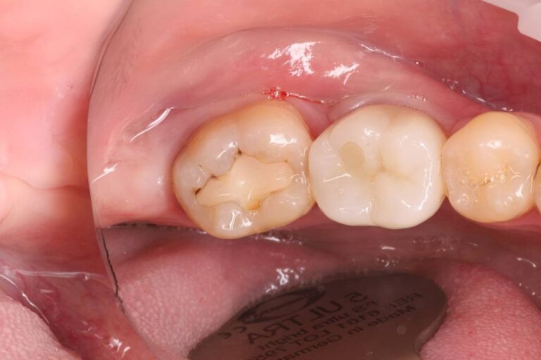 Removal of carious lesions and anatomical composite restoration of the tooth.