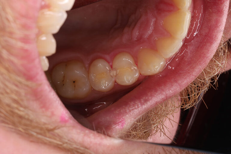Removal of carious lesions and anatomical composite restoration of the tooth.