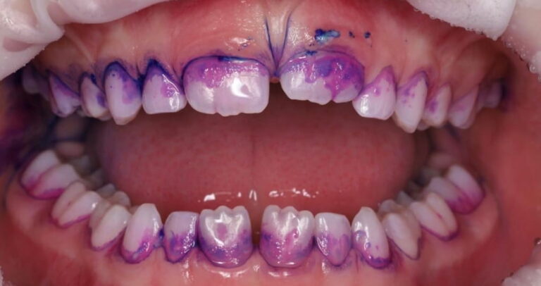 Professional oral hygiene for a child under 8 years of age.