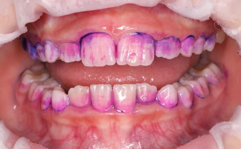 Professional oral hygiene for a child under 8 years of age.