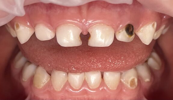 Comprehensive treatment of primary teeth under general anesthesia