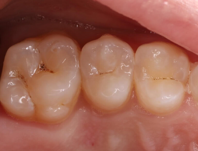 Aesthetic and functional restoration of posterior teeth