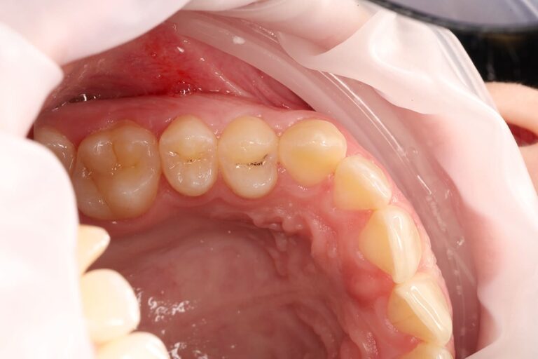 Aesthetic dental restoration with anatomical reconstruction.