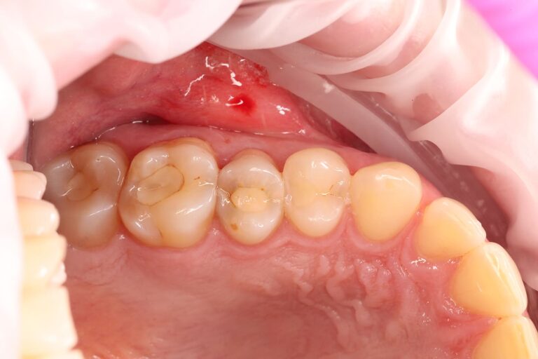 Aesthetic and functional composite restoration of tooth 25.
