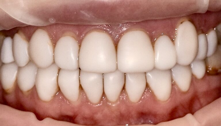 Comprehensive Aesthetic Smile Rehabilitation Through Replacement of Composite Veneers with Ceramic Restorations