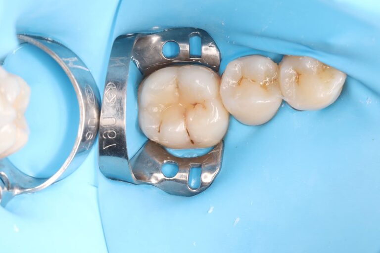 Treatment of a secondary carious lesion.