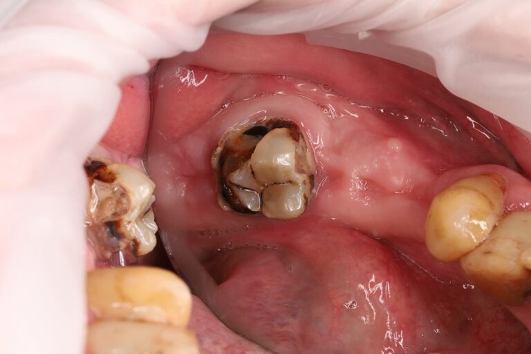 Caries treatment and composite core restoration of the tooth for subsequent prosthetic rehabilitation.
