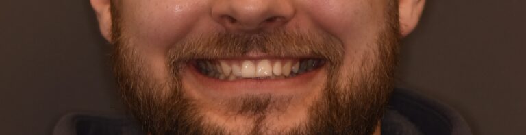 Restoration of Anterior Teeth Aesthetics Using Ceramic Veneers