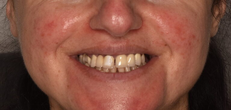 Comprehensive Restoration of Masticatory Function and Smile Esthetics According to the All-on-4 Concept