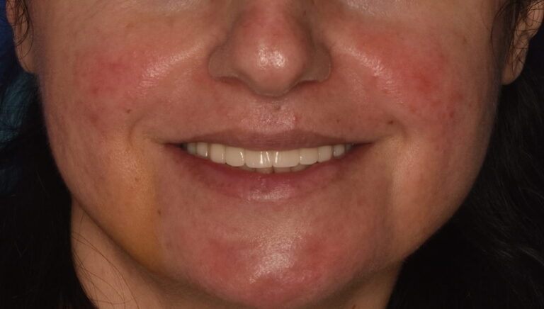 Comprehensive Restoration of Masticatory Function and Smile Esthetics According to the All-on-4 Concept